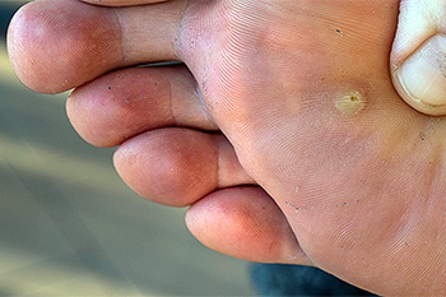 plantar-warts-may-be-rough-or-smooth